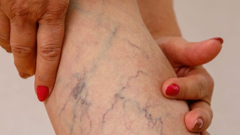 Escleroterapia
