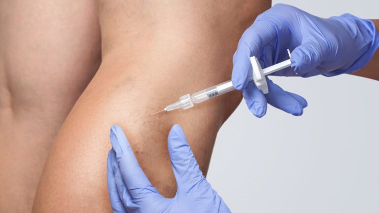 La Escleroterapia
