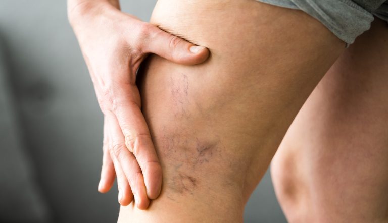 Adiós a las varices